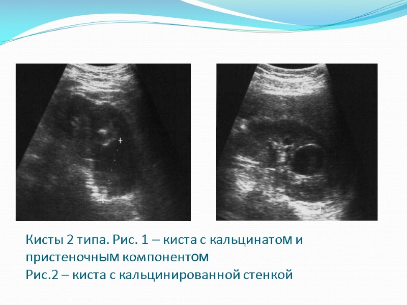 Кисты 2 типа. Рис. 1 – киста с кальцинатом и пристеночным компонентом Рис.2 –